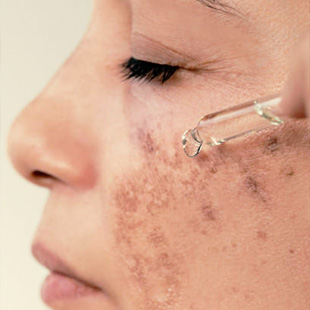 /storage/photos/ConcernType/Hyperpigmentation.jpg